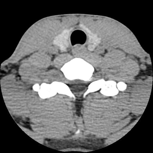 File:C5 facet fracture (Radiopaedia 58374-65499 Axial non-contrast 75).jpg