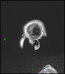 CNS manifestations of NF1 - optic pathway glioma, neurofibroma, dural ectasia (Radiopaedia 37874-39805 Sagittal FLAIR 140).jpg