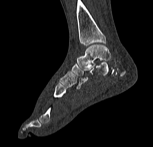 Calcaneal fracture - Sanders type 4 (Radiopaedia 90179-107370 Sagittal bone window 48).jpg