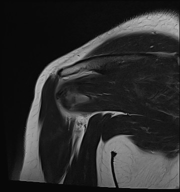 File:Calcific tendinitis of the infraspinatus tendon (Radiopaedia 87256-103537 Coronal T2 16).jpg