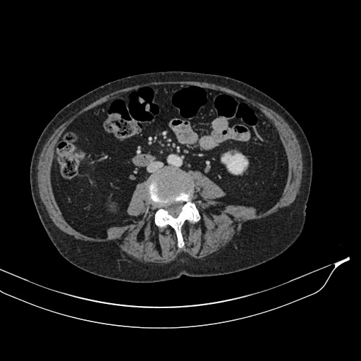 Calcified adrenal glands and Spigelian hernia (Radiopaedia 49741-54988 A 121).jpg