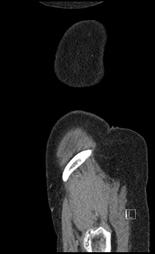 Calcified adrenal glands and Spigelian hernia (Radiopaedia 49741-54988 C 6).jpg