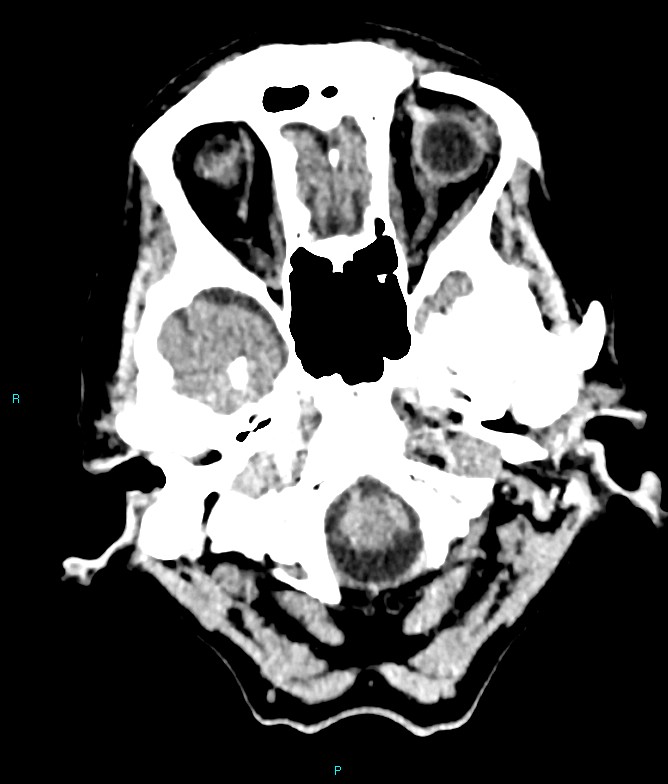 Calcified cerebral emboli from left ventricular thrombus (Radiopaedia 84420-99758 Axial non-contrast 80).jpg