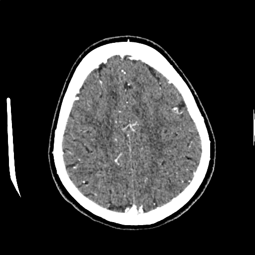 Calcified cerebral hydatid cyst (Radiopaedia 65603-74717 Axial with contrast 61).jpg