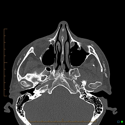 Calcified facial augmentation fillers (Radiopaedia 79514-92679 Axial bone window 13).jpg
