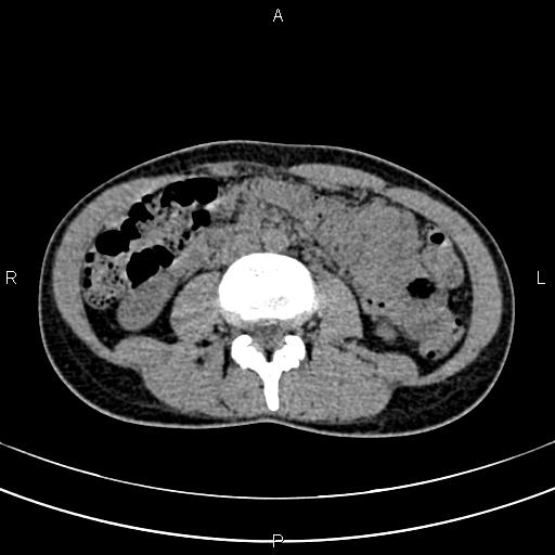 File:Calcified hepatic hydatid cyst (Radiopaedia 83870-99072 Axial non-contrast 95).jpg