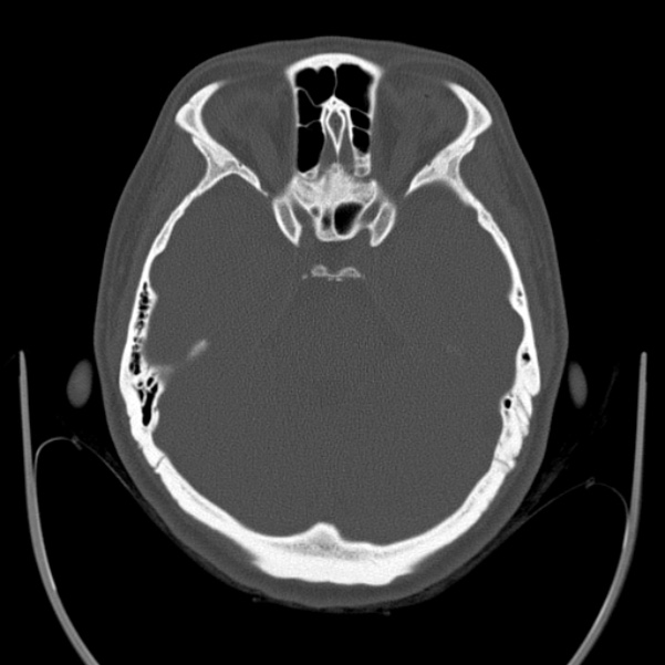 Calvarial osteoma (Radiopaedia 36520-38079 Axial bone window 35).jpg