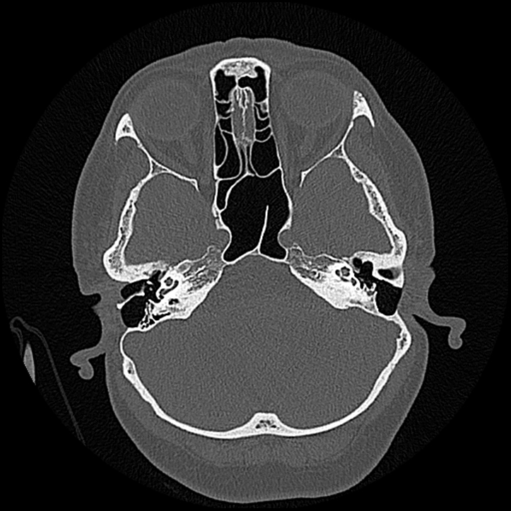Canal up mastoidectomy (Radiopaedia 78108-90638 Axial bone window 70).jpg