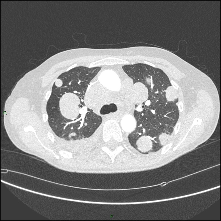 Cannonball metastases (Radiopaedia 82110-96150 Axial lung window 74).jpg