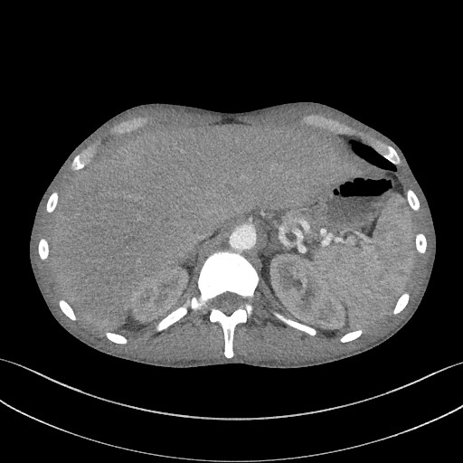 Cannonball metastases - testicular choriocarcinoma (Radiopaedia 84510-99891 B 103).jpg