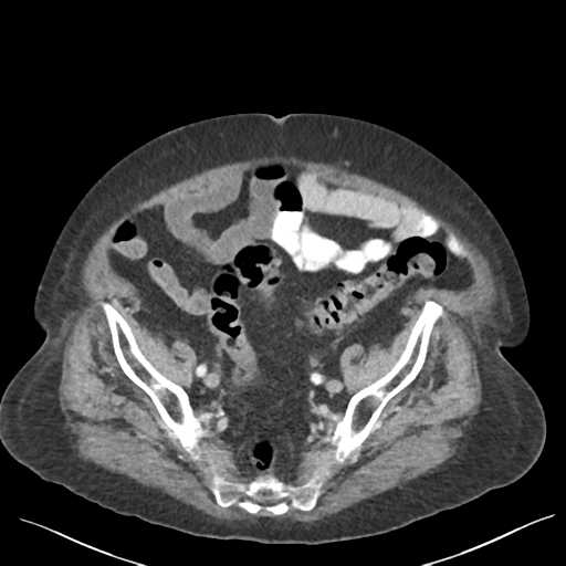 Cannonball metastases from endometrial cancer (Radiopaedia 42003-45031 E 61).png