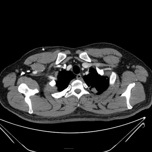 File:Cannonball pulmonary metastases (Radiopaedia 67684-77101 D 31).jpg