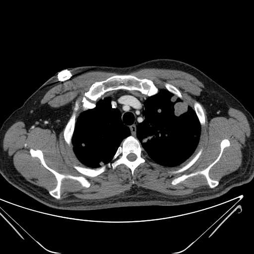 File:Cannonball pulmonary metastases (Radiopaedia 67684-77101 D 57).jpg