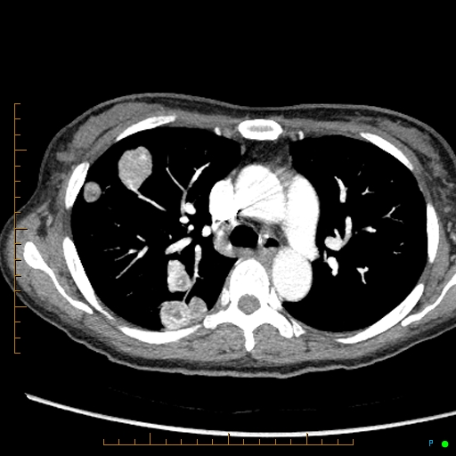 Canonball lung metastasis (Radiopaedia 77634-89837 B 33).jpg