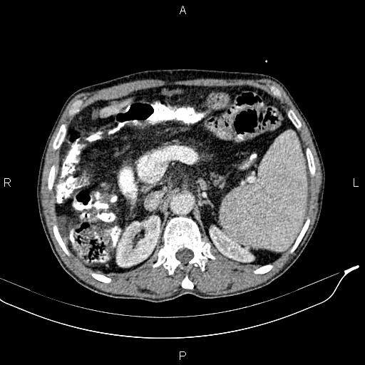 File:Caput medusae sign - portal hypertension (Radiopaedia 64007-72759 A 28).jpg