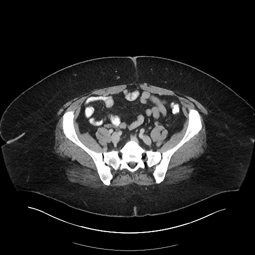 Carcinoid tumor - terminal ileum (Radiopaedia 60931-68739 A 96).jpg
