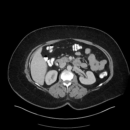 File:Carcinoid tumor - terminal ileum (Radiopaedia 60931-68739 Axial 35).jpg