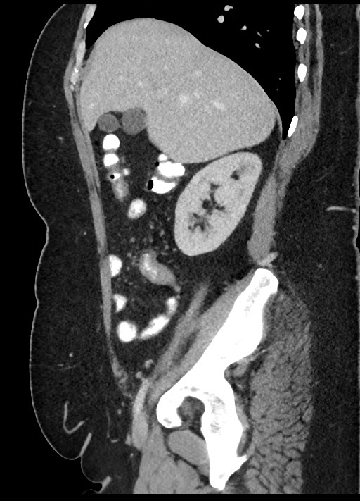 Carcinoid tumor - terminal ileum (Radiopaedia 60931-68739 C 72).jpg