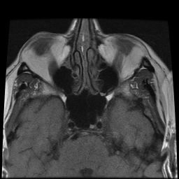 File:Carcinoid tumor of the ileum with metastasis to orbit (Radiopaedia 28165-28424 Axial T1 1).jpg