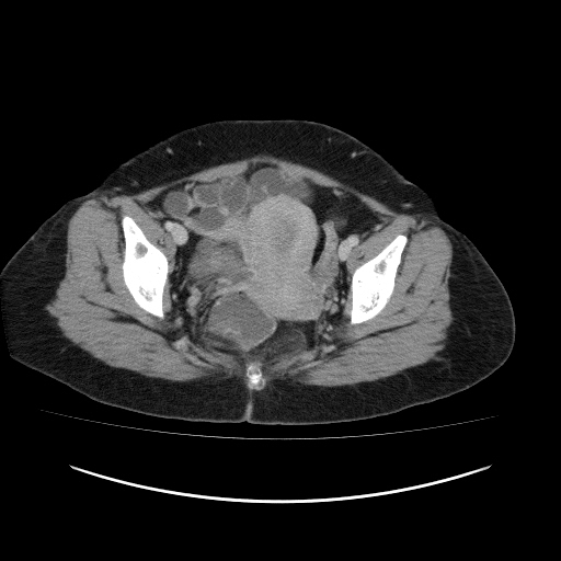 Carcinoma colon - hepatic flexure (Radiopaedia 19461-19493 A 115).jpg