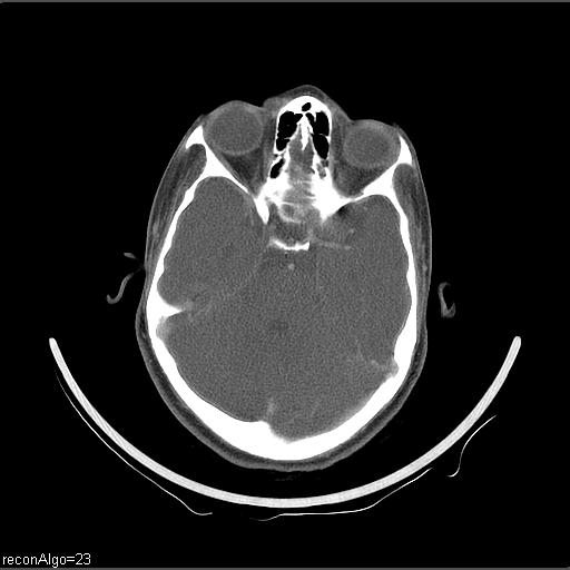 File:Carcinoma of the maxillary antrum (Radiopaedia 53805-59888 Axial C+ delayed 68).jpg