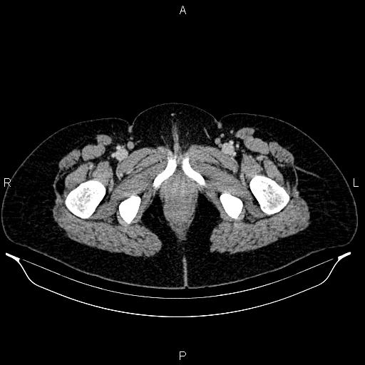 Carcinoma of uterine cervix (Radiopaedia 85861-101700 A 78).jpg