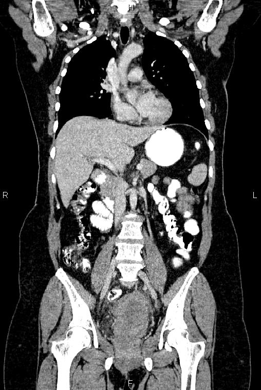 Carcinoma of uterine cervix (Radiopaedia 85861-101700 C 27).jpg