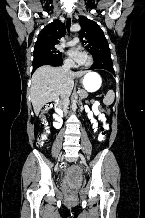 Carcinoma of uterine cervix (Radiopaedia 85861-101700 C 29).jpg