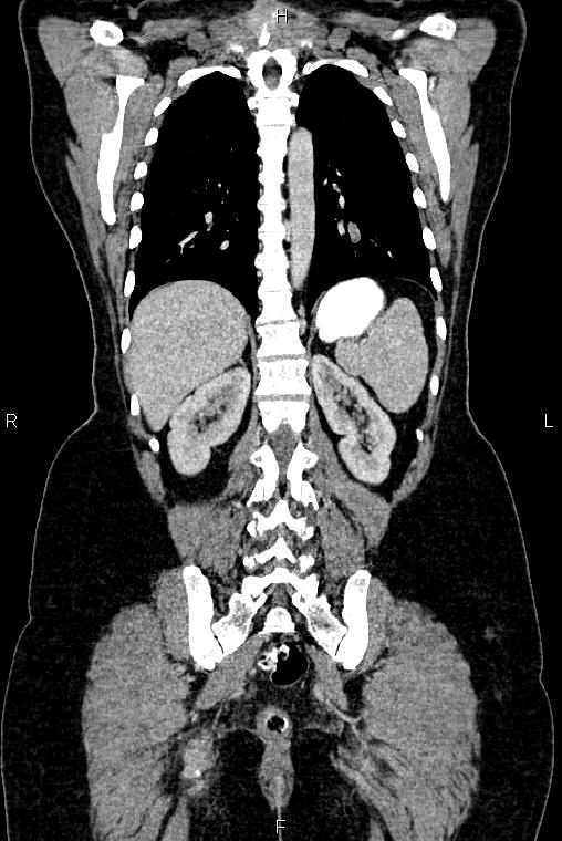 Carcinoma of uterine cervix (Radiopaedia 85861-101700 C 42).jpg