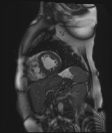 Cardiac amyloidosis (Radiopaedia 51404-57150 Sagittal CINE SSFP 149).jpg