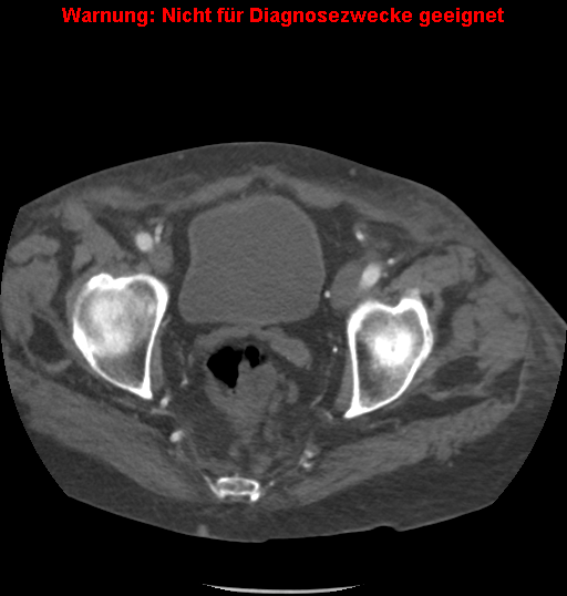 File:Cardiac perforation following transcatheter aortic valve implantation (Radiopaedia 23714-23863 B 3).png