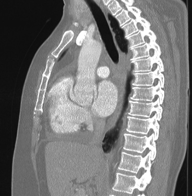 Cardiac sarcoidosis (Radiopaedia 74548-85534 Sagittal lung window 48).jpg