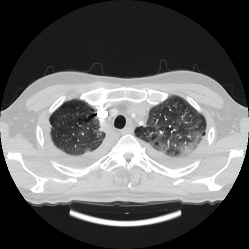 Cardiac tamponade (Radiopaedia 78607-91368 Axial lung window 10).jpg