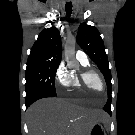Cardiac tumor - undifferentiated pleomorphic sarcoma (Radiopaedia 45844-50134 Coronal non-contrast 21).png