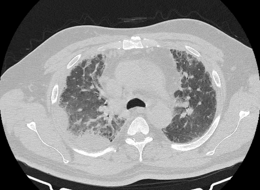 Cardiogenic pulmonary edema (Radiopaedia 68180-77678 Axial lung window 28).jpg