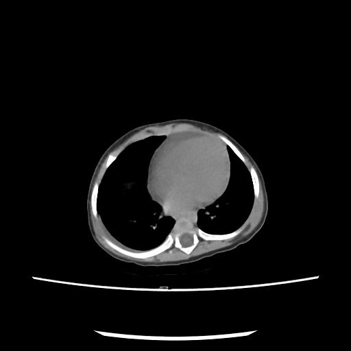 Caroli disease with autosomal recessive polycystic kidney disease (ARPKD) (Radiopaedia 89651-106703 E 3).jpg
