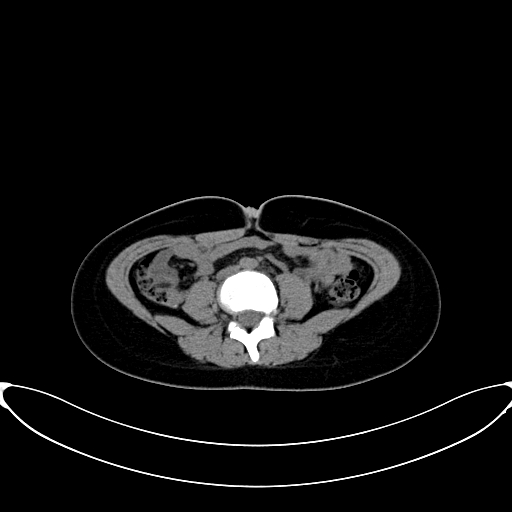 Caroli disease with medullary sponge kidney (Radiopaedia 82622-96804 Axial non-contrast 43).jpg