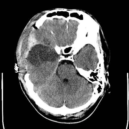 File:Carotid arterial dissection (Radiopaedia 30001-30548 Axial non-contrast 8).jpg