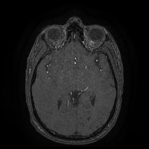Carotid arterial dissection with acute cerebral infarction (Radiopaedia 26636-26784 MRA 87).jpg