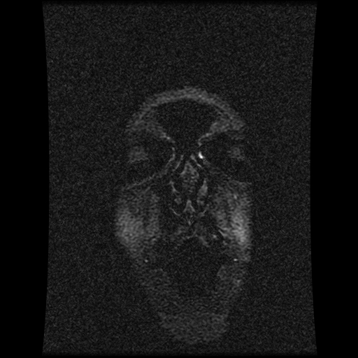 Carotid arterial dissection with acute cerebral infarction (Radiopaedia 26636-26784 MRV 152).jpg