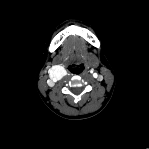 File:Carotid body tumor (Radiopaedia 39845-42300 B 35).jpg