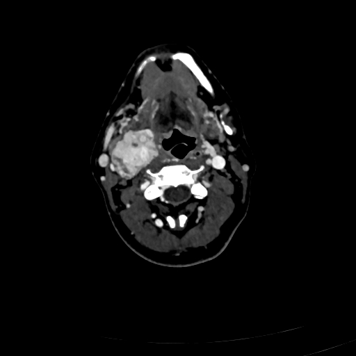 Carotid body tumor (Radiopaedia 83615-98727 D 56).jpg