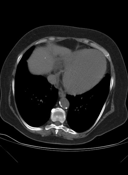 File:Caseous mitral annular calcification (Radiopaedia 61219-69122 Axial non-contrast 17).jpg