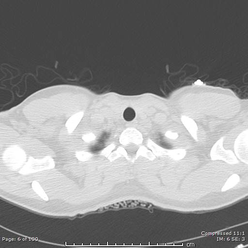 Catamenial pneumothorax (Radiopaedia 54382-60600 Axial non-contrast 6).jpg