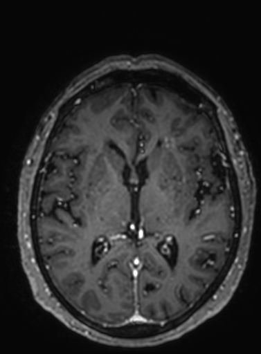 Cavernous hemangioma of the cerebellar falx (Radiopaedia 73025-83724 Axial T1 C+ 162).jpg