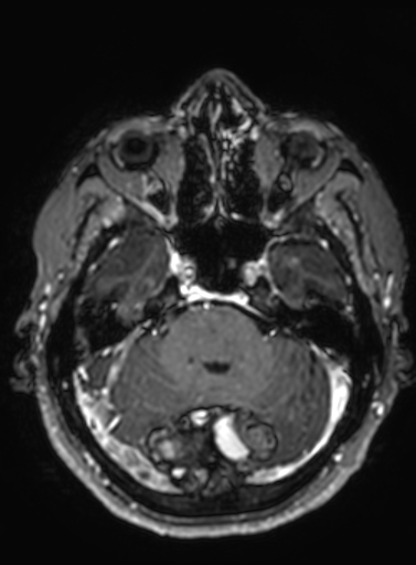 Cavernous hemangioma of the cerebellar falx (Radiopaedia 73025-83724 Axial T1 C+ 241).jpg