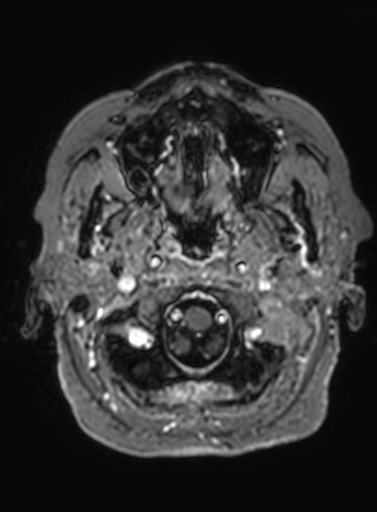 File:Cavernous hemangioma of the cerebellar falx (Radiopaedia 73025-83724 Axial T1 C+ 318).jpg