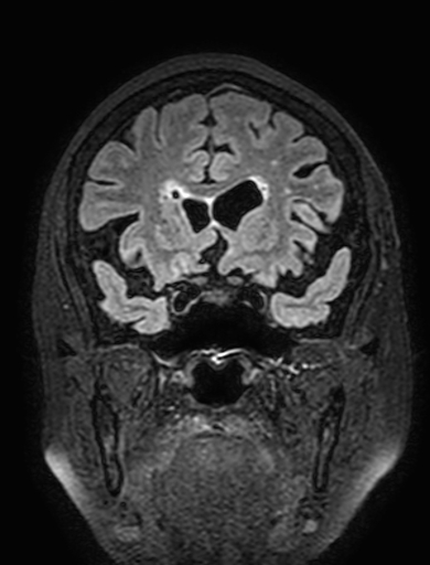 Cavernous hemangioma of the cerebellar falx (Radiopaedia 73025-83724 Coronal FLAIR 113).jpg