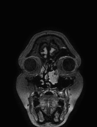 Cavernous hemangioma of the cerebellar falx (Radiopaedia 73025-83724 Coronal FLAIR 13).jpg