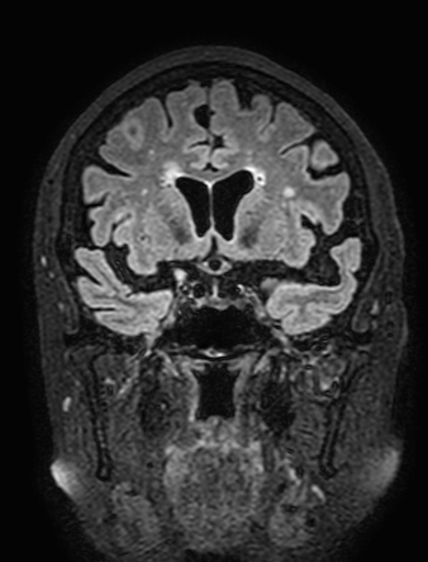 Cavernous hemangioma of the cerebellar falx (Radiopaedia 73025-83724 Coronal FLAIR 133).jpg